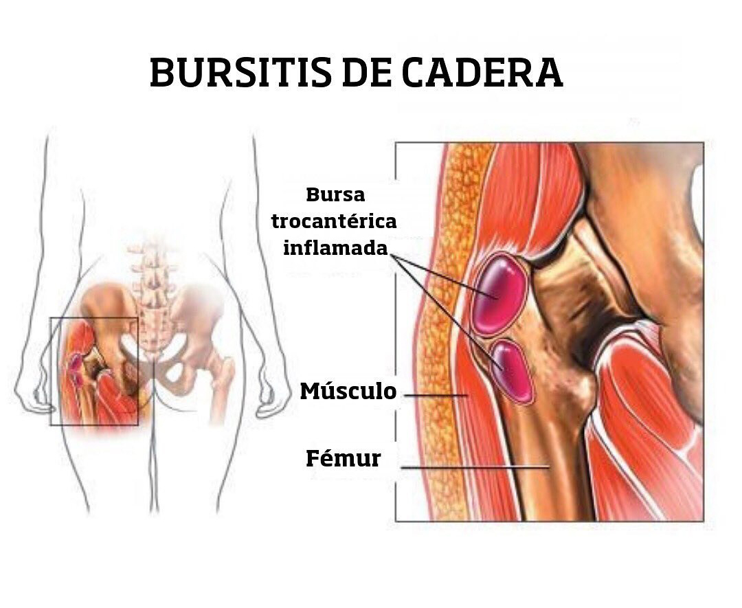Diagnóstico de la trocanteritis o bursitis trocantérea 