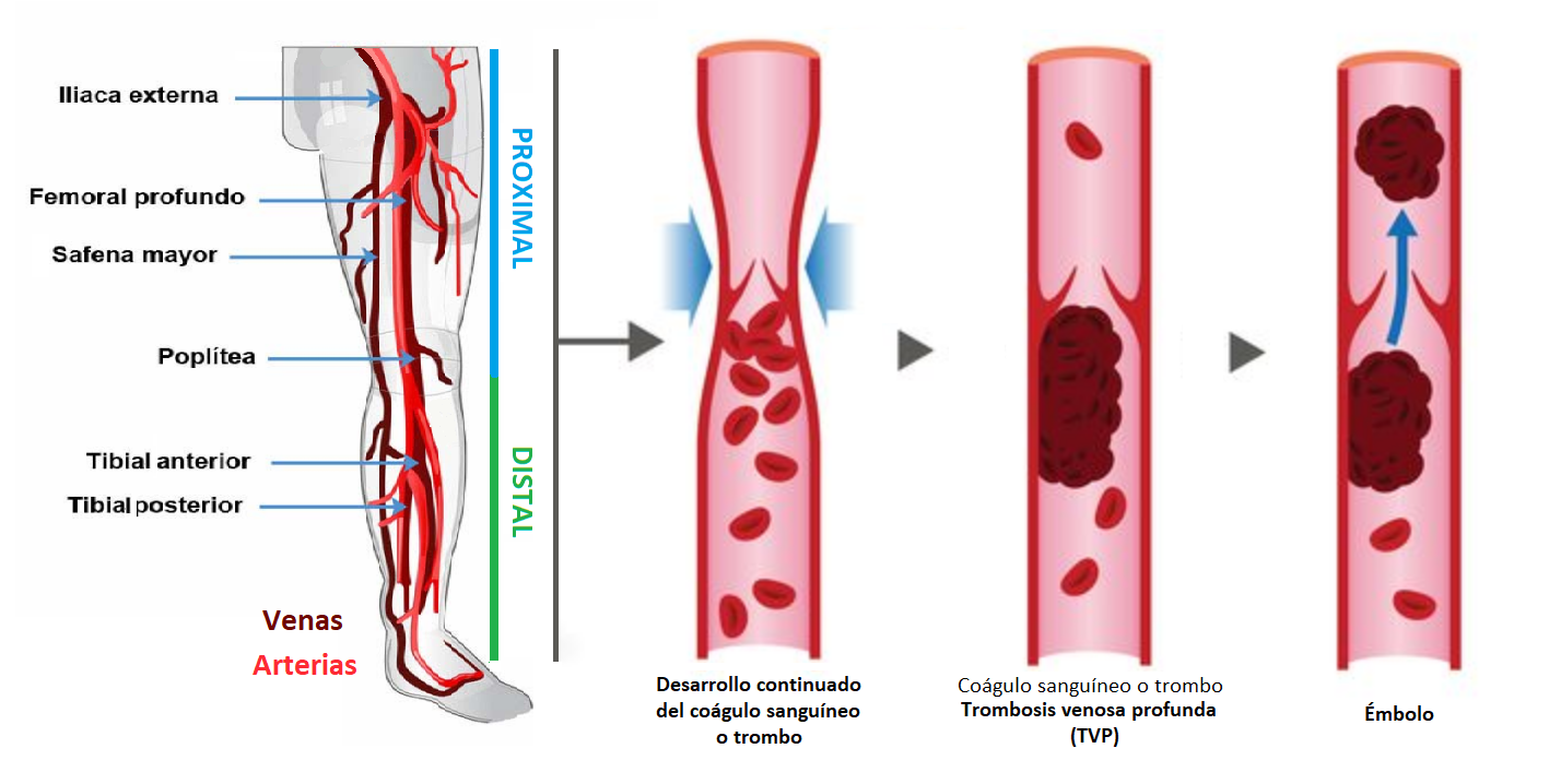 Desarrollo de la trombosis venosa profunda trombosis venosa profunda