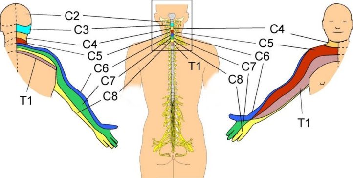 Cervicobraquialgia: Qué es, causas, síntomas, tratamiento y consejos | FisioOnline